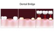 Dental bridge procedure, eps10