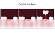 Dental implant procedure, eps10