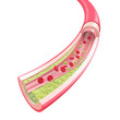 Arteriosklerose