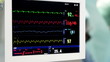drip with monitor in operation room with surgeons