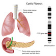Cystic fibrosis, eps10