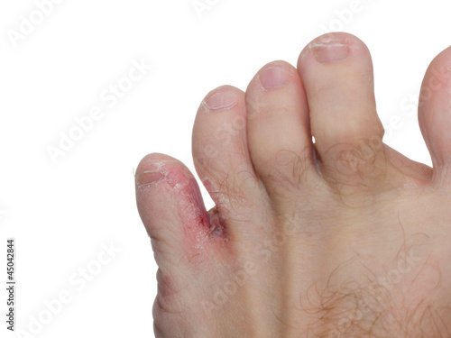 Photo: Athlete's foot (tinea pedis) Athlete's foot (tinea pedis)