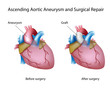 Ascending aortic aneurysm and open surgery, eps8
