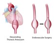 Thoracic aortic aneurysm and surgery, eps10