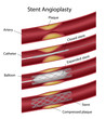 Stent angioplasty, eps10