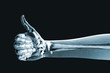 dramatized x ray of a hand thumbs up