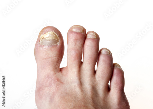Photo: Toenail fungus Toenail fungus