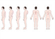 educational illustration deformstion of the spine 