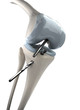 Knee arthroscopy stage 1