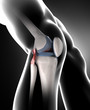 Knee with arthrisis