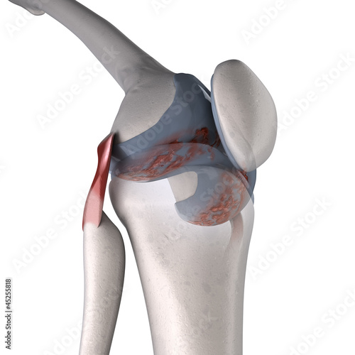 Illustration: arthritis of knee arthritis of knee