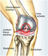 Illustration: Vorderer totaler Kreuzbandriss Vorderer totaler Kreuzbandriss