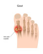 Gout of the big toe, eps10