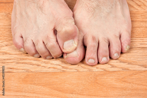 Photo: Itchy feet Itchy feet