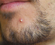pimple