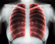 x-ray