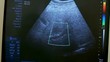 Sonogram of patient