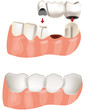 ponte dentale prima e dopo-dental bridge before and after