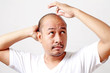 Baldness