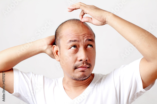 Photo: Baldness Baldness