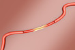Arteriosklerose
