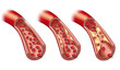 Arteriosklerose