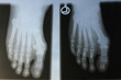 Foto: Radiographie Hallux valgus Radiographie Hallux valgus