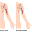 Muscular dystrophy, eps10