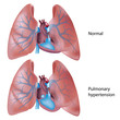 Pulmonary hypertension, eps10