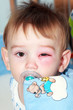 little boy - dangerous stings from wasps near the eye