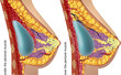 Plastic surgery of breast implants. Vector