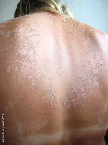 Photo: Burn from the sun on the body Burn from the sun on the body