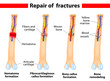 Fracture and repair. Vector scheme.