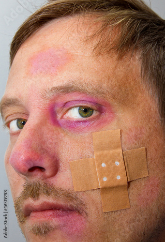 Photo: Gesichtsverletzungen Gesichtsverletzungen