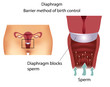 Barrier contraceptive method- Diaphragm
