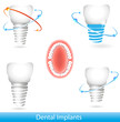 Dental implants