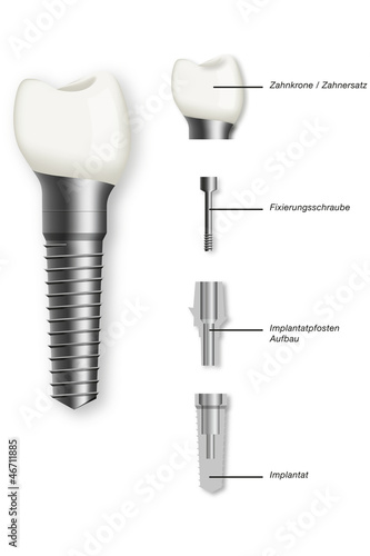 Illustration: Zahnimplantat Modell Zahnimplantat Modell