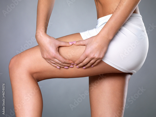 Photo: cellulite skin on her legs cellulite skin on her legs