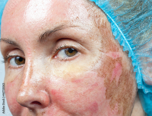 Photo: Cosmetology. New skin after a chemical peeling, Cosmetology. New skin after a chemical peeling,