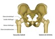 Arthritis im Gelenk Illustration mit Beschreibung deutsch