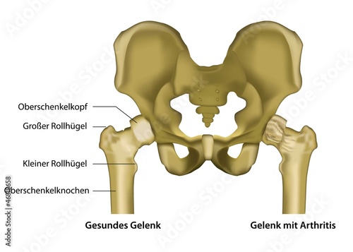 Vektor: Arthritis im Gelenk Illustration mit Beschreibung deutsch Arthritis im Gelenk Illustration mit Beschreibung deutsch