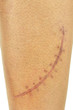 Close-up of a big, fresh scar