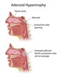 Adenoid hypertrophy, eps10
