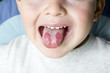 Niño con lengua geográfica mostrando los síntomas