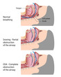 Snoring and sleep apnea, eps10
