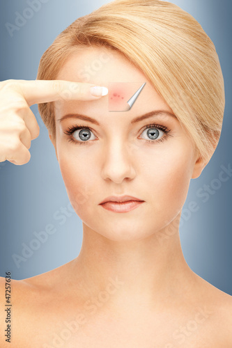 Photo: no more acne no more acne