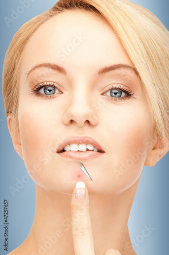 Photo: no more acne no more acne