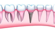 Dental Implant detailed view. 3D Illustration