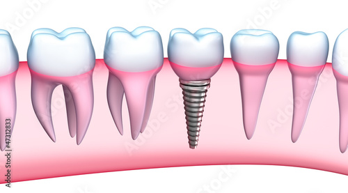 Illustration: Dental Implant detailed view. 3D Illustration Dental Implant detailed view. 3D Illustration
