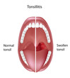 Tonsillitis, eps8